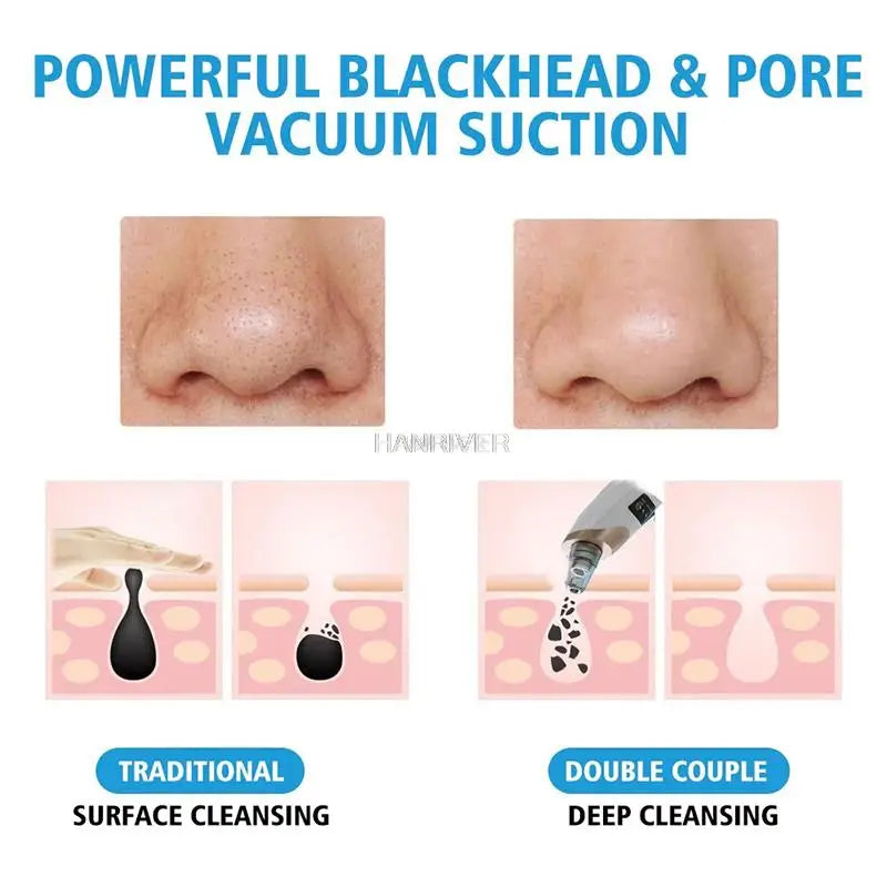 Blackhead Remover Vacuum Acne Pimple Black Spot